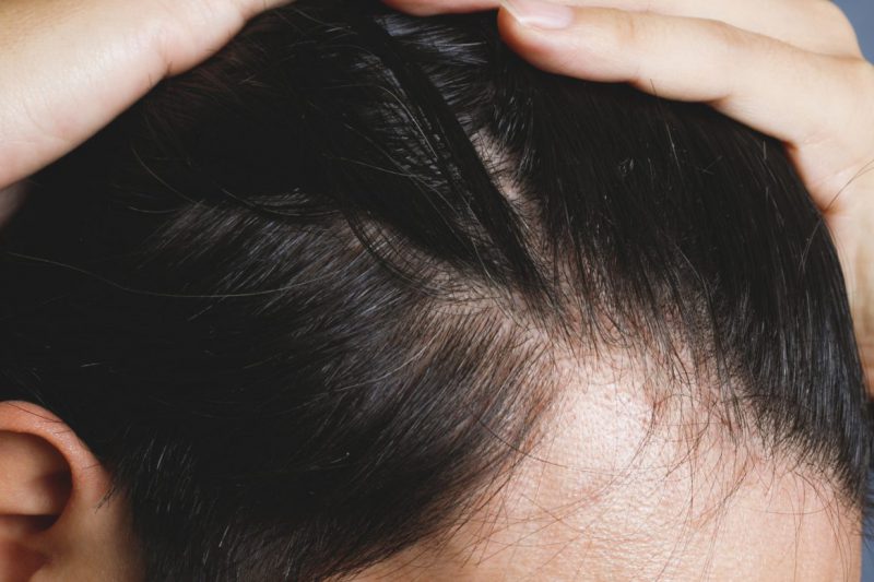男性の脱毛症の原因について徹底解説｜症状の種類や治療方法についても詳しく紹介します