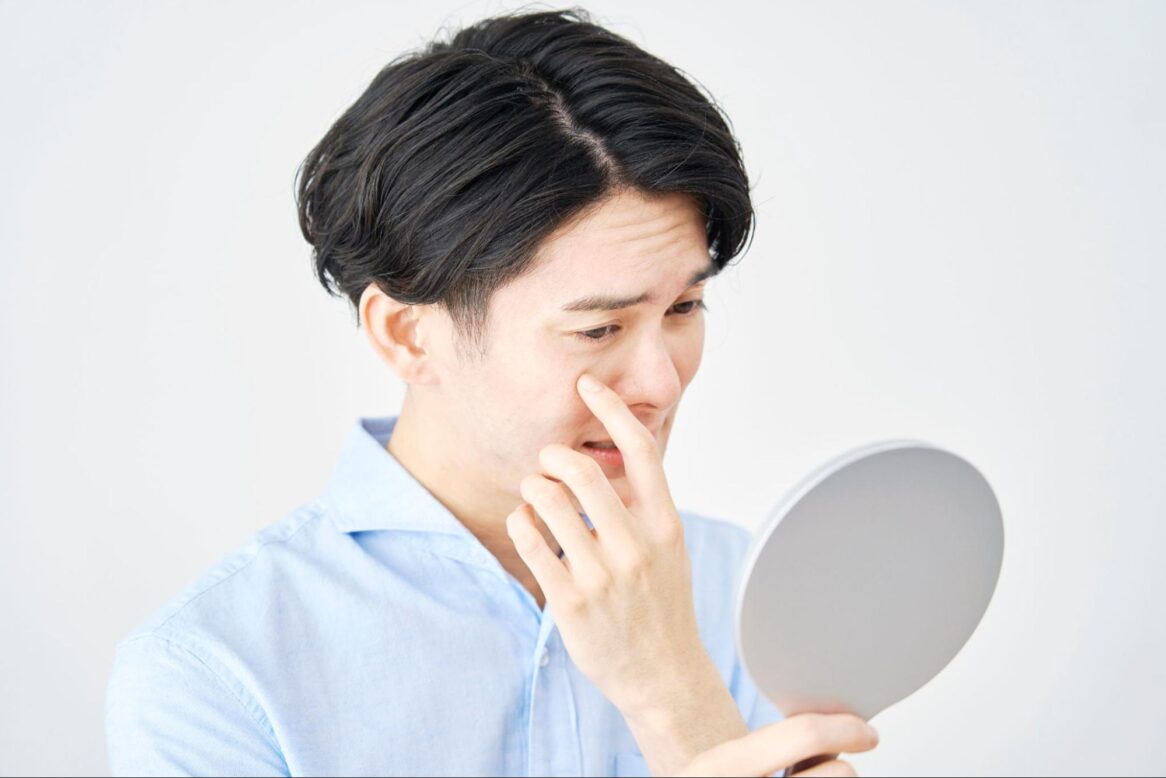 ヒアルロン酸 マリオネットライン