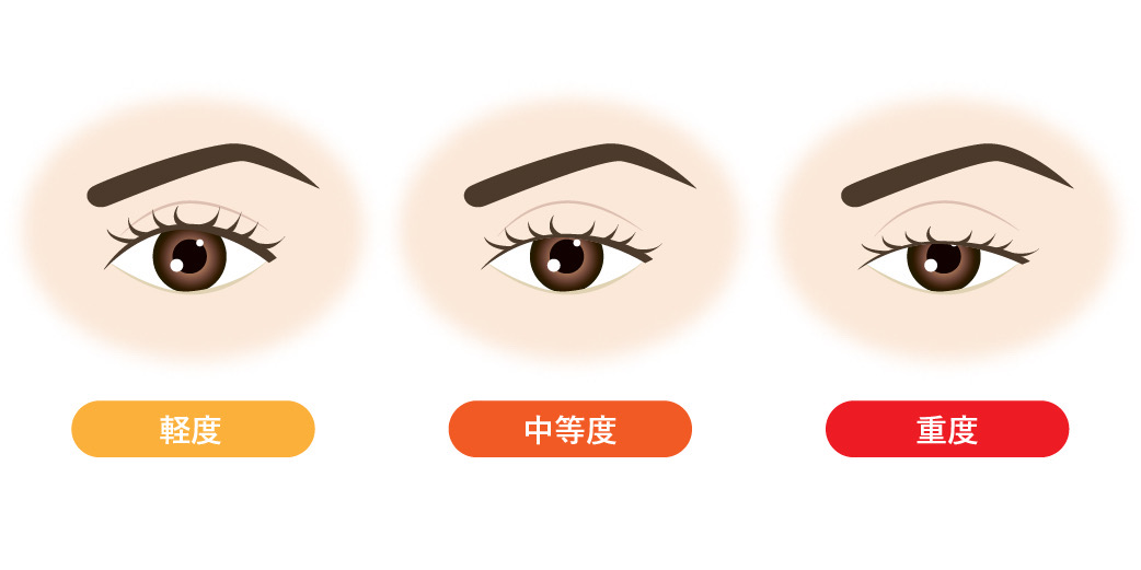 眼瞼下垂症の見た目の特徴
