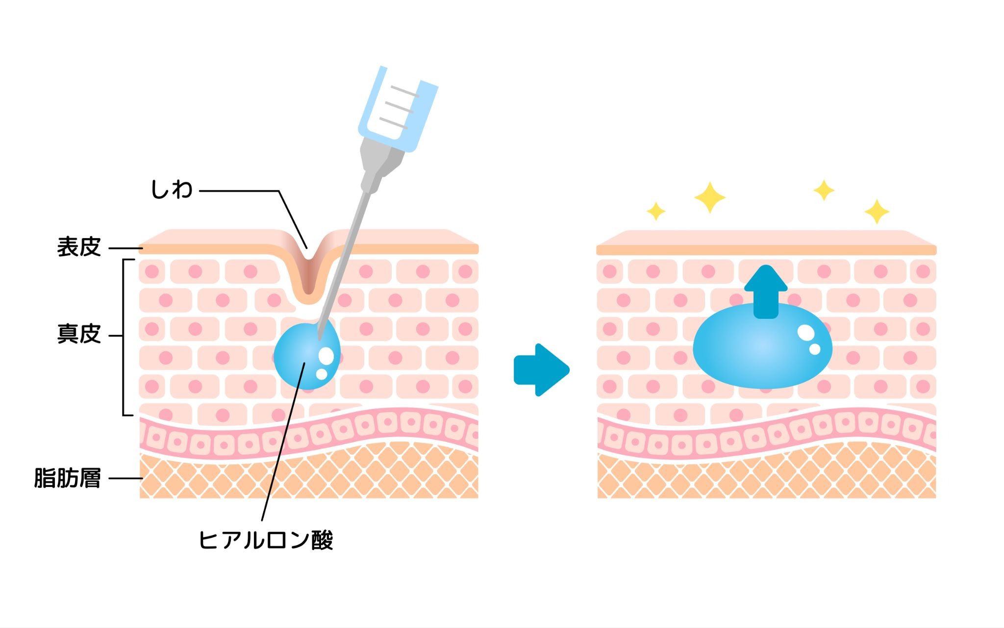 ヒアルロン酸注射の仕組みについて説明するイラスト