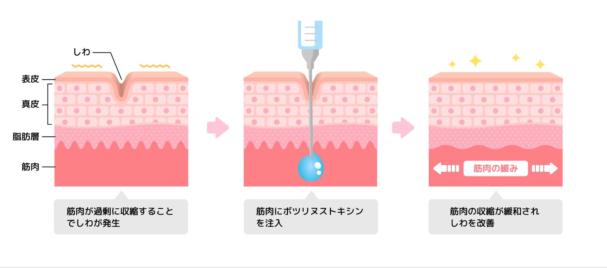 ボトックスの仕組みについて説明するイラスト