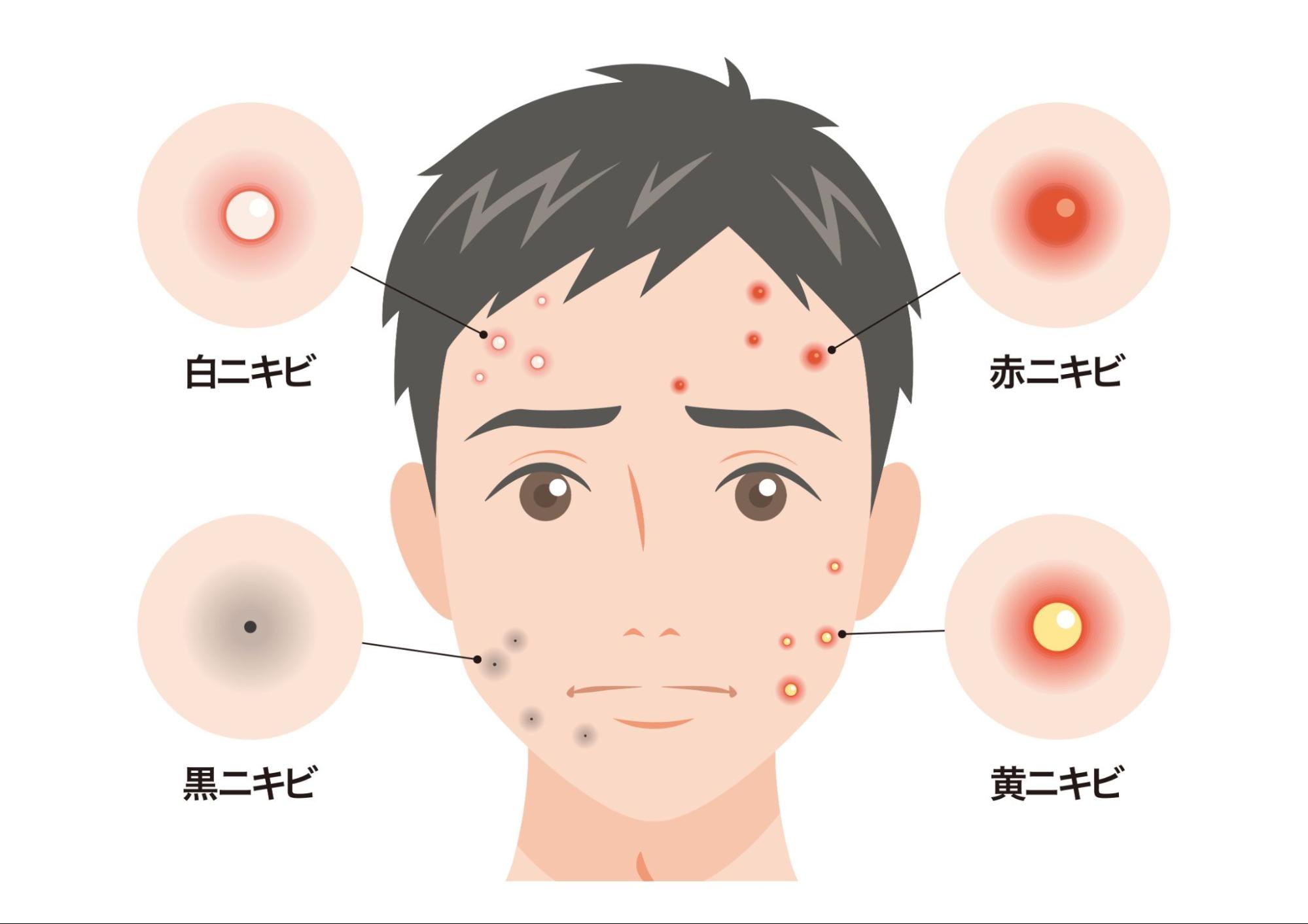 ニキビの種類