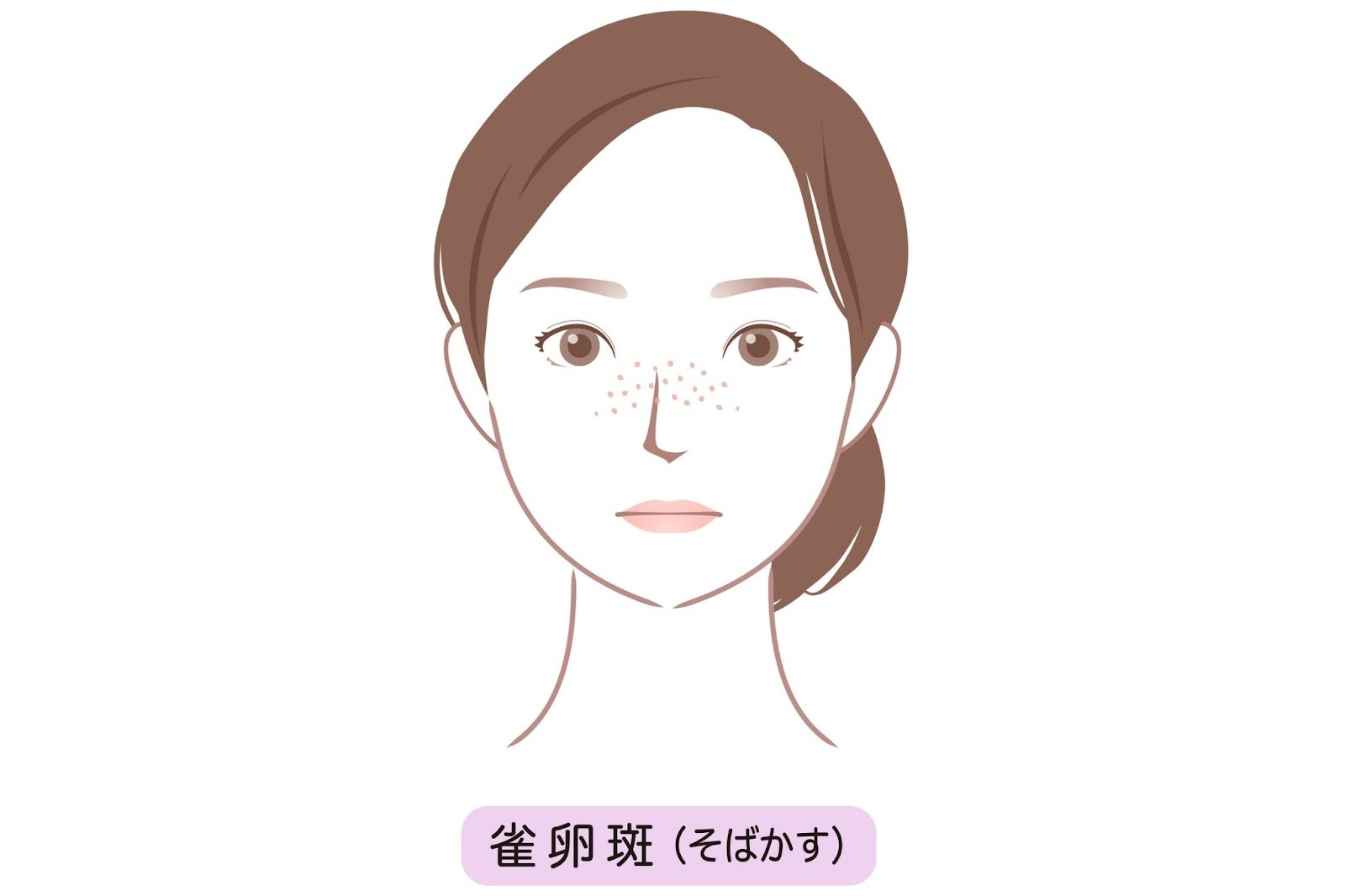 そばかsのイメージイラスト。女性の顔にそばかすがある