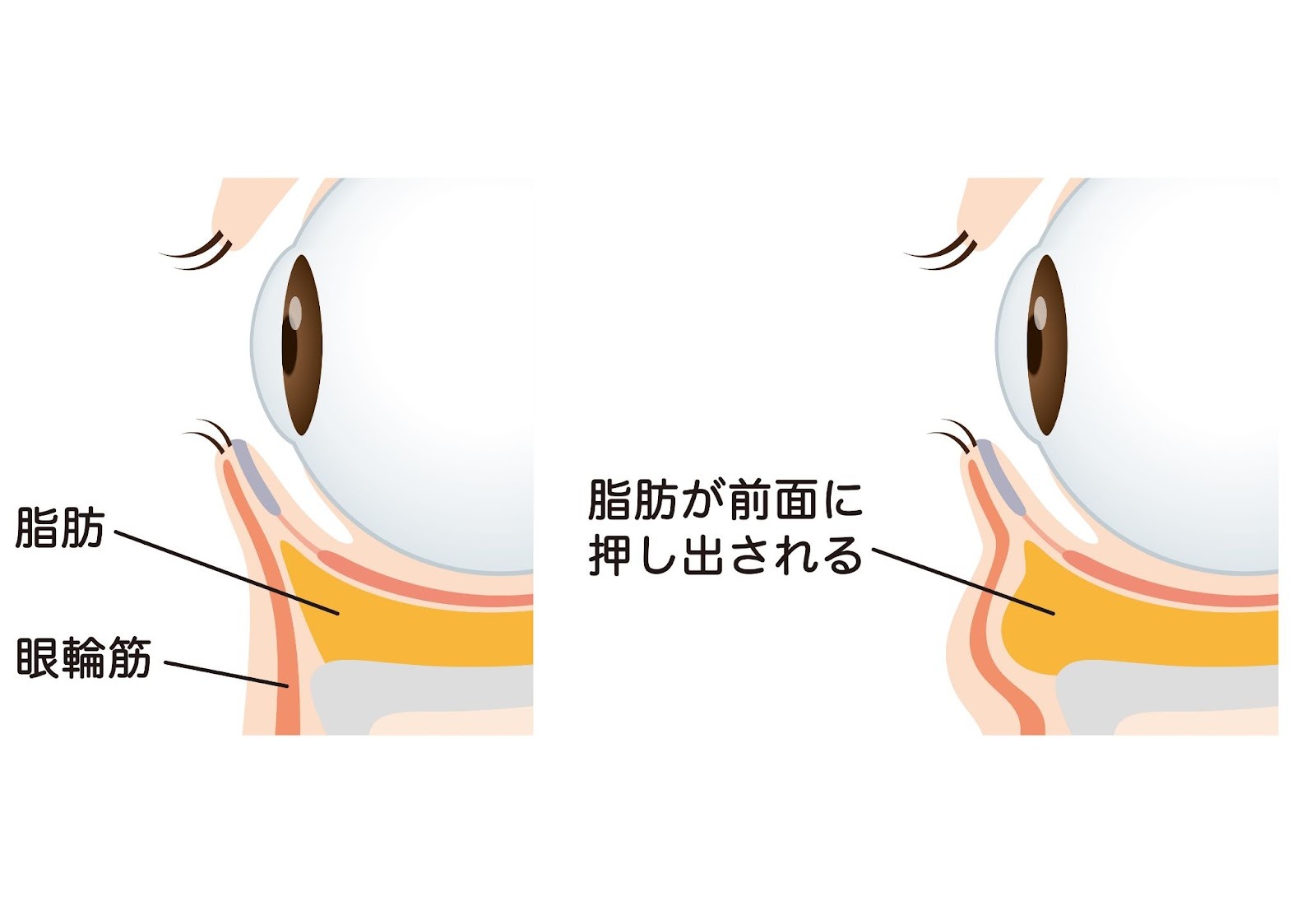 目の下のたるみ・ふくらみが発生する仕組みの図解。眼輪筋の衰えによって眼窩脂肪が押し出され、目の下のたるみ・ふくらみが発生している