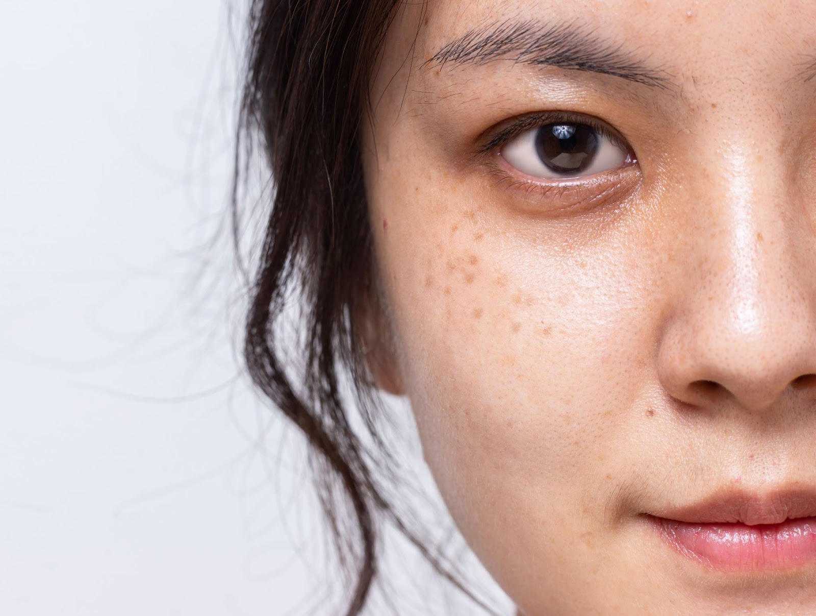 顔にシミがある女性