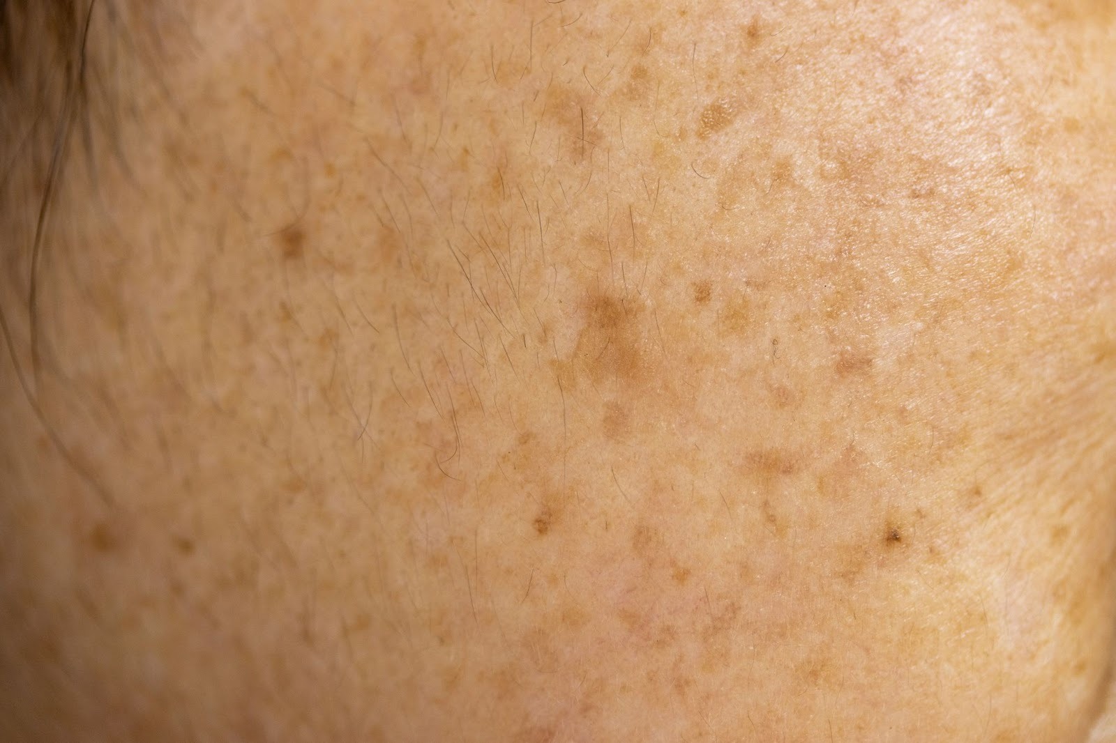 顔にできたシミのアップ写真