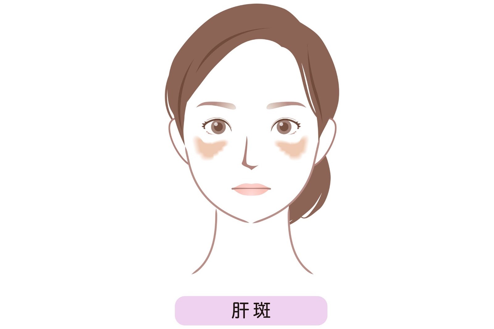 肝斑のイメージイラスト。女性の顔に肝斑がある